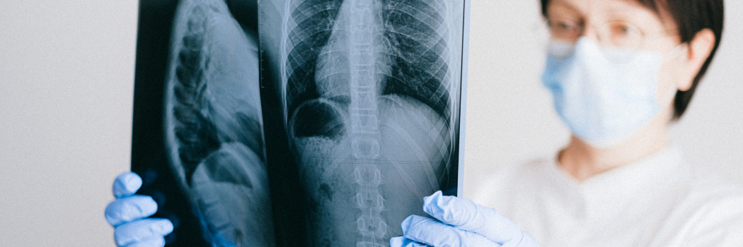 Woman in White Long Sleeve Shirt Holding Blue and White X-Ray of Lungs