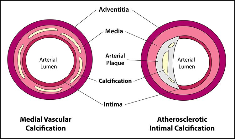 Diagram illustrating arterial calcification