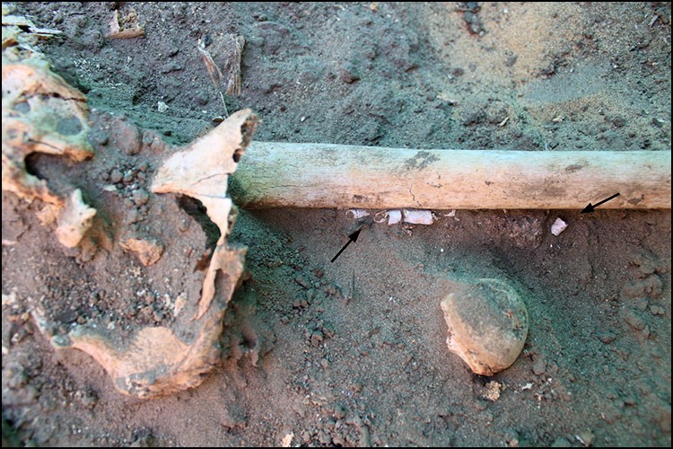 Photograph of part of a female human skeleton under excavation with an arrow highlighting the presence of calcifications of the femoral artery next to this person’s femur/thigh bone