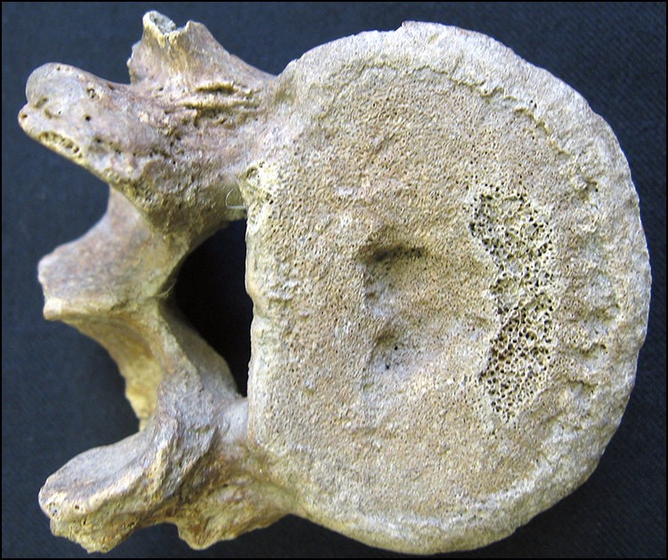 Photograph of a vertebra from a human spine with depressed central surface