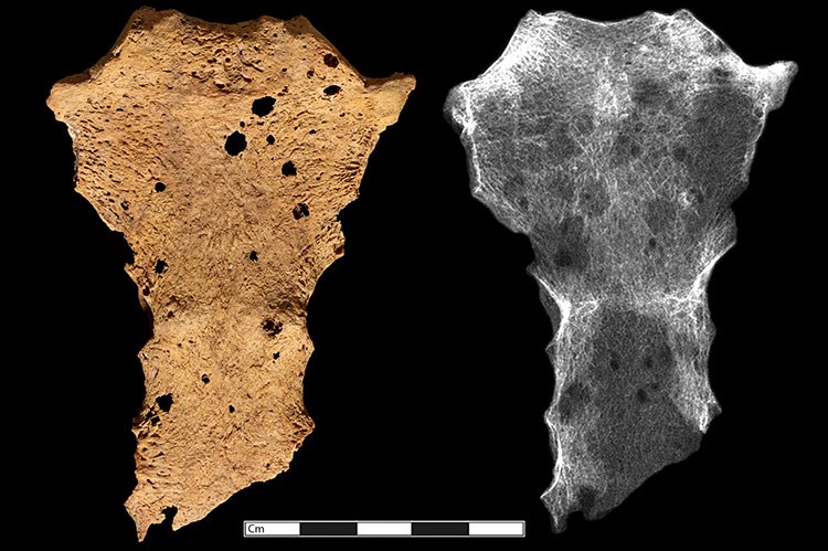 Photograph and x-ray of a male human breast bone from Amara West, Sudan showing signs of cancer