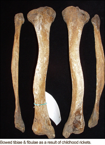 Human Bones showing signs of rickets